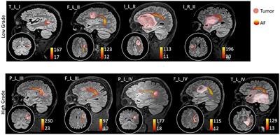 From Neurosurgical Planning to Histopathological Brain Tumor Characterization: Potentialities of Arcuate Fasciculus Along-Tract Diffusion Tensor Imaging Tractography Measures